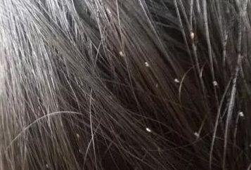 头发虱子视频,视频带你了解防治方法