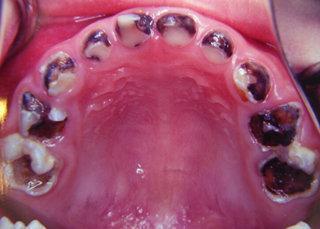 蛀牙虫视频,牙齿健康的隐形杀手